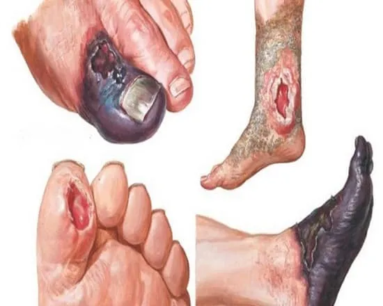 عفونت زخم پای دیابتی در مرجع مدیریت زخم