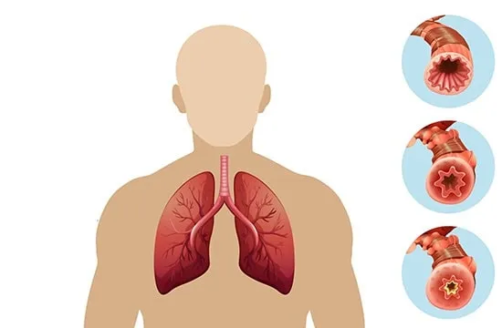 اثرات مزمن جوشکاری با co2