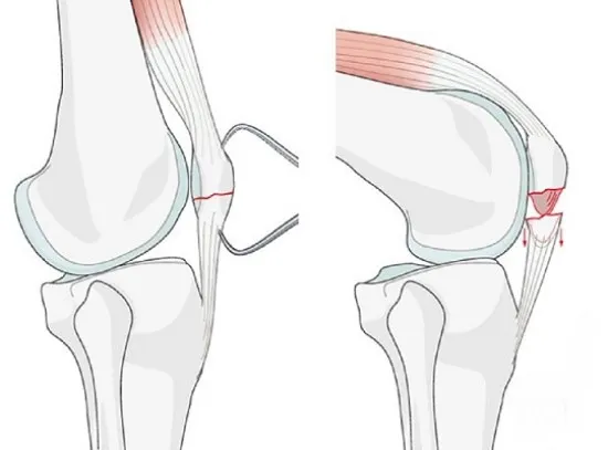 fracture کنده شده