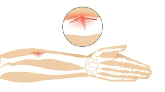 شکستگی گرین استیک